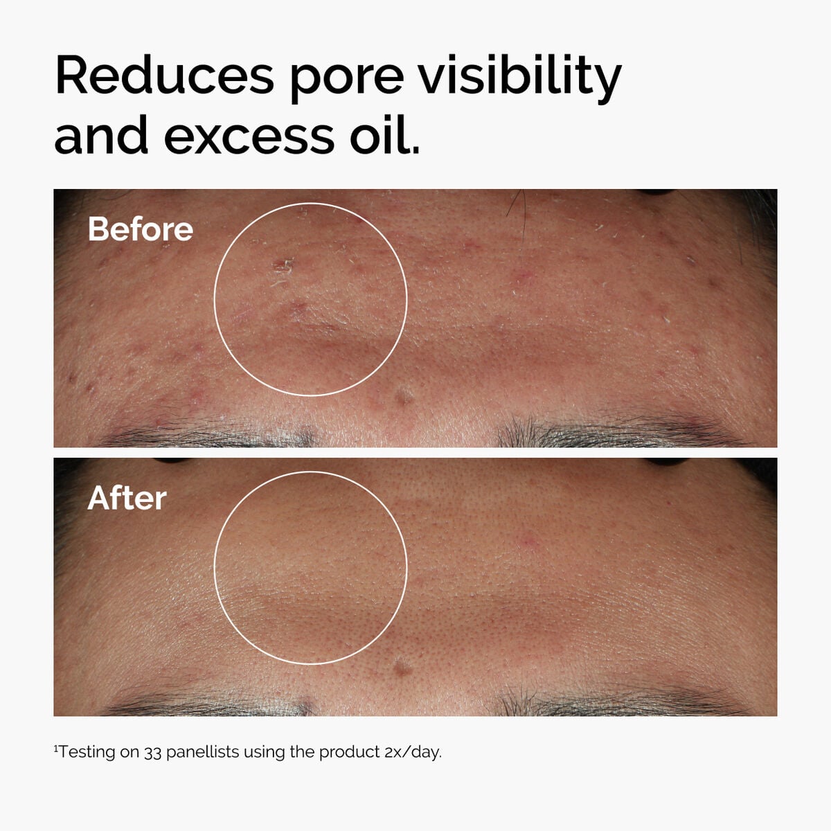 niacinamide-10-zinc-1-b4 ord-niacinamide-zinc-blemish-serum-before-after-pores.jpg