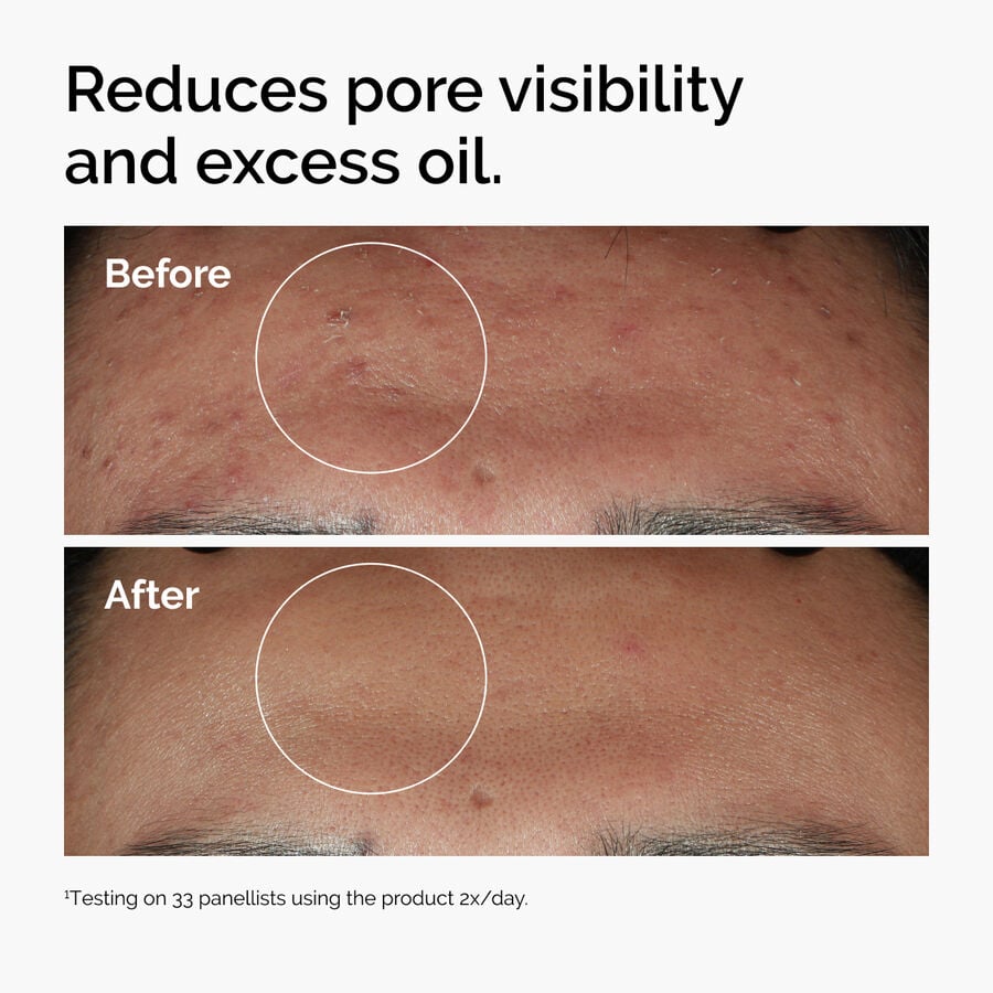 niacinamide-10-zinc-1-b4 ord-niacinamide-zinc-blemish-serum-before-after-pores.jpg
