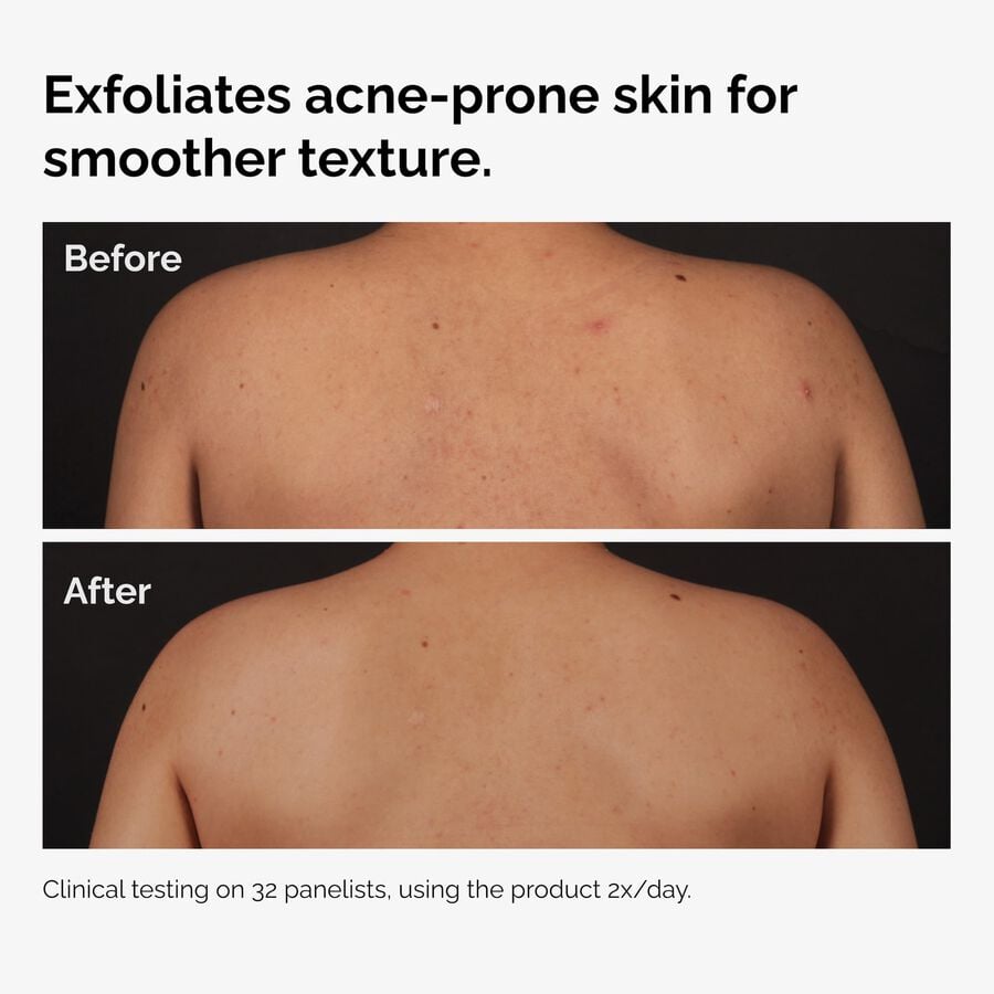 the-body-care-collection-b8 ord-salicylic-acid-body-serum-before-after-graphic-NA.jpg