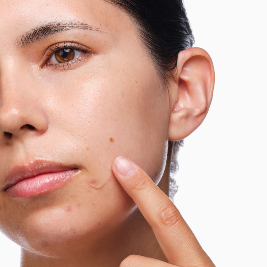 the-acne-set-i7 rdn-the-acne-set-application.png